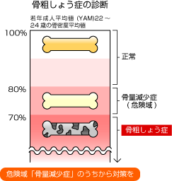 骨粗しょう症の診断