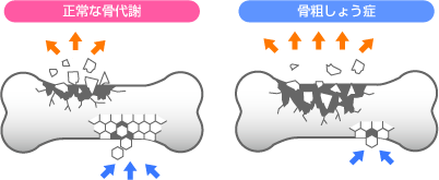 造骨と破骨のバランス